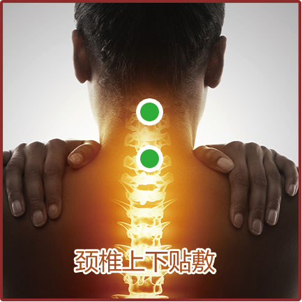神經(jīng)根型、脊髓型頸椎病貼敷位置示意圖